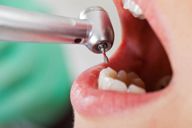 Best Emergency Dental Care for Abscessed Tooth in Marshville, NC